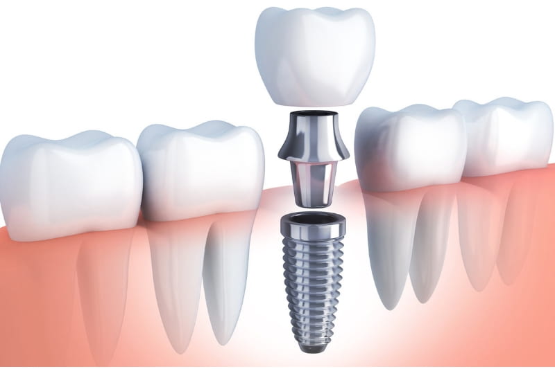 implant-abutment-crown-image1