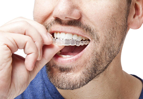 Man with aligners image