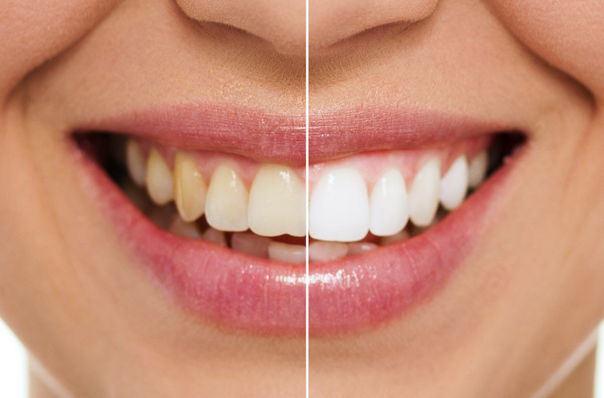 teeth-whitening-lowres-image-2